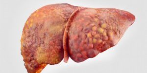 11491_liver-Cirrhosis-ts-477578412_jpg_7d645182-7a40-4870-a8b1-61cd6be570bb-e1459827723974