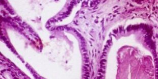 Typical-pathological-appearance-of-human-chronic-pancreatitis-Fibrosis-loss-of-acinar_Q320