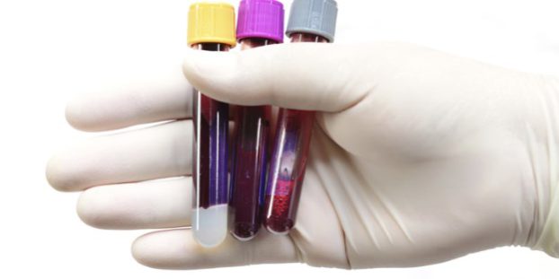 When-Viral-Hepatitis-C-Goes-Chronic-722×406