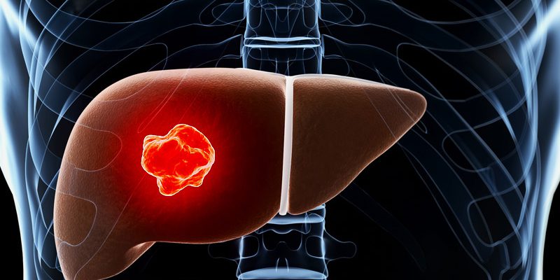 dt_160415_liver_cancer_tumor_800x600