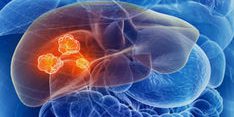 dt_170123_liver_cancer_800x600